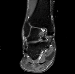 관절염환자오른쪽발목 X-ray사진
