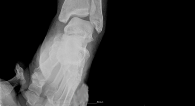 스트레스를 주어 외측 인대가 손상되어 벌어진 발목 x-ray
