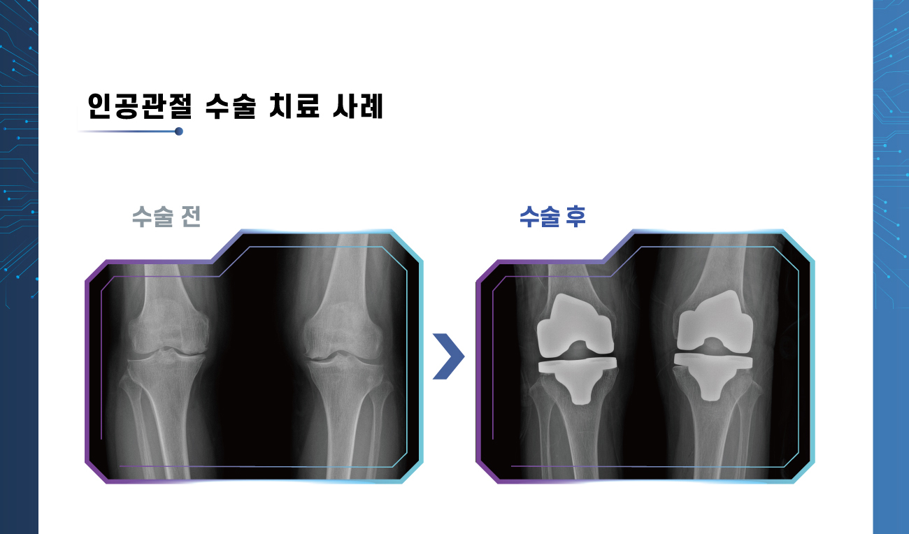 인공관절 수술 치료 사례