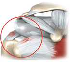 회전근개에 염증이 난 사진