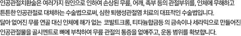 인공관절치환술은 여러가지 원인으로 인하여 손상된 무릎, 어깨, 족부 등의 관절부위를, 인체에 무해하고 튼튼한 인공관절로 대체하는 수술법으로써, 심한 퇴행성관절염 치료의 대표적인 수술법입니다. 닳아 없어진 무릎 연골 대신 인체에 해가 없는 코발트크롬, 티타늄합금등의 금속이나 세라믹으로 만들어진 인공관절물을 골시멘트로 뼈에 부탁하여 무릎관절의 통증을 없애주고, 운동 범위를 확보합니다.