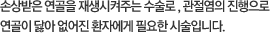 손상받은 연골을 재생시켜주는 수술로, 관절염의 진행으로 연골이 닳아 없어진 환자에게 필요한 시술입니다.